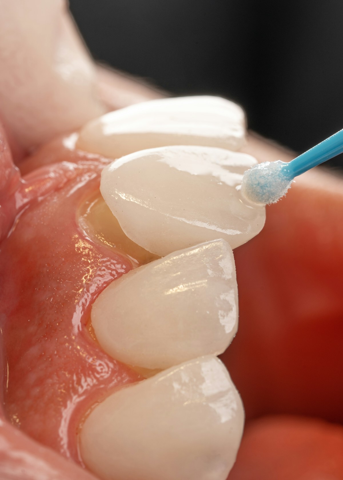 Zirconia veneers for strength